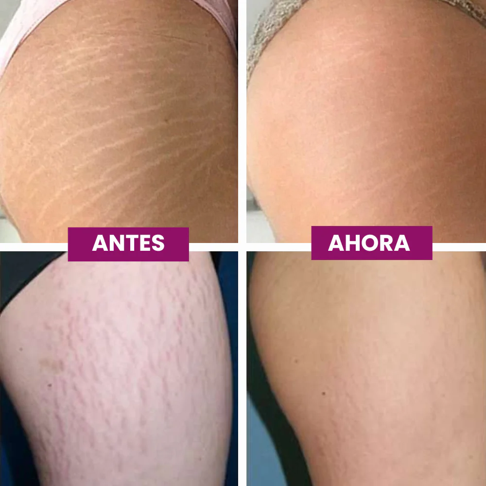 Tratamiento intensivo contra estrías Adeus™ - Image 3